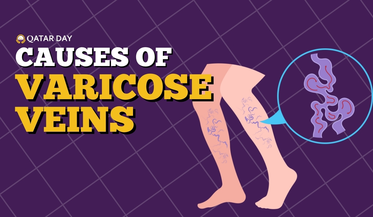 Causes of Varicose Veins